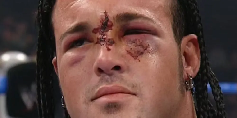 Mũi của Joey Mercury sau cú va chạm thang